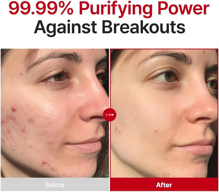 PURITO SEOUL Azelaic Acid 10% Kojic Tea Tree Serum 30ml | Brightening Blemish Serum